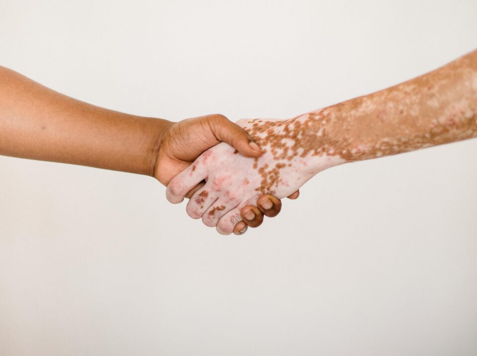skin_vitiligo